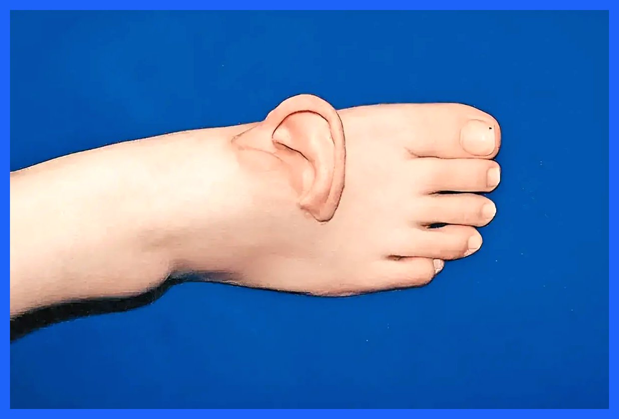 پیوند لاله گوش زن چینی از پا نجات یافت