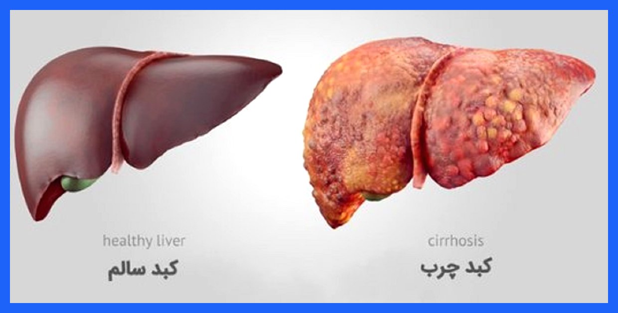 تغذیه مناسب برای درمان کبد چرب: راهکارهایی که باید بدانید (اینفوگرافیک)