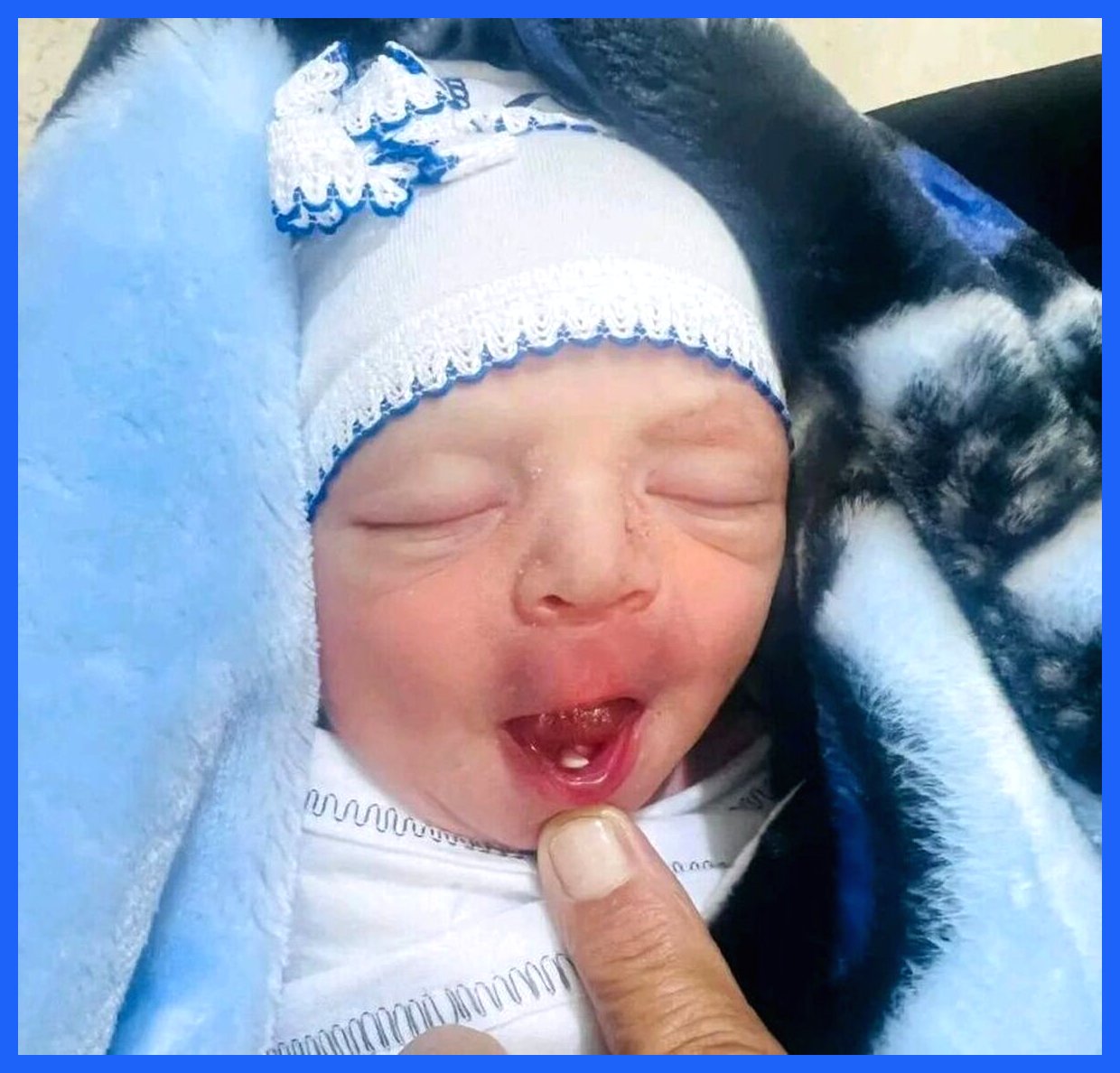 نوزادی نادر با دندان‌های اولیه به دنیا آمد! (+عکس)