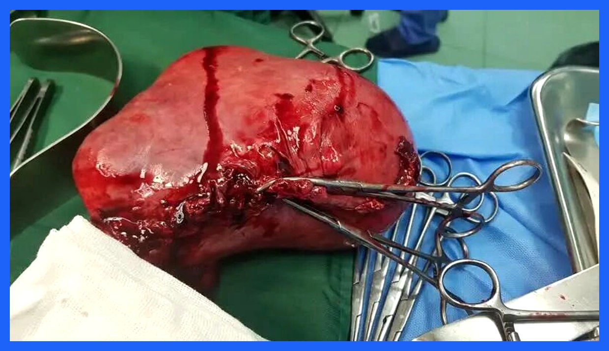 خروج توده ۲ کیلویی از شکم بیمار، معجزه‌ای در دنیای پزشکی!