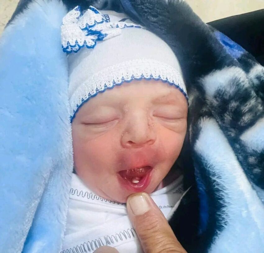 نوزادی نادر با دندان‌های اولیه به دنیا آمد! (+عکس)