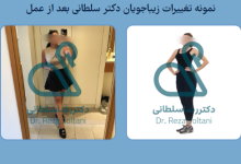 نتایج عمل لیپوماتیک چطور و چه زمان قابل مشاهده است؟