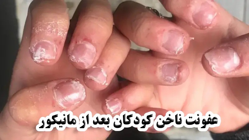 عفونت ناخن کودکان بعد از مانیکور