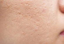 اشتباهات رایج که منافذ پوست را بازتر میکند و راه حلهای سریع