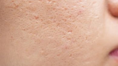 اشتباهات رایج که منافذ پوست را بازتر میکند و راه حلهای سریع