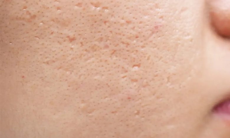 اشتباهات رایج که منافذ پوست را بازتر می‌کند و راه حل‌های سریع