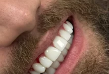 کیفیت و دقت در ایمپلنت