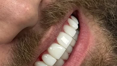 کیفیت و دقت در ایمپلنت