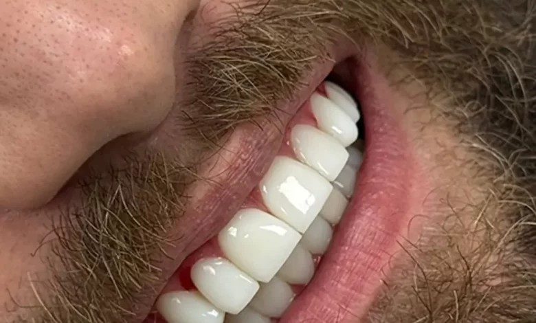 کیفیت و دقت در ایمپلنت