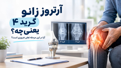 آرتروز زانو گرید 4 یعنی چه